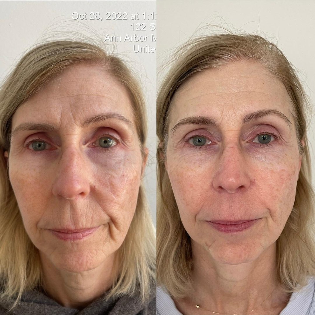 KrX Youthplex Face Lift Toning Solution